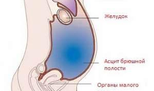 жидкость в брюшной полости