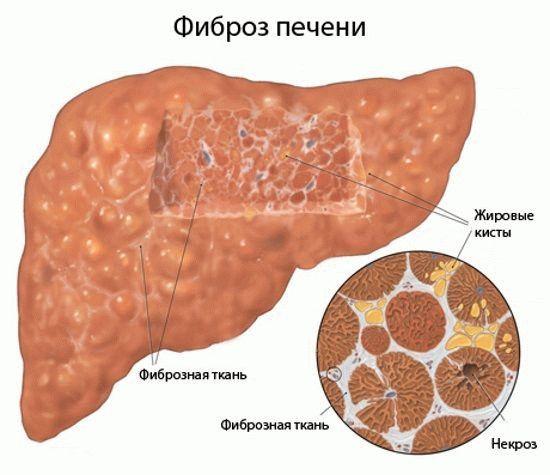 фиброз печени