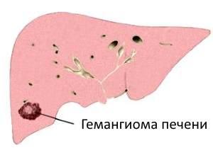 капиллярная гемангиома