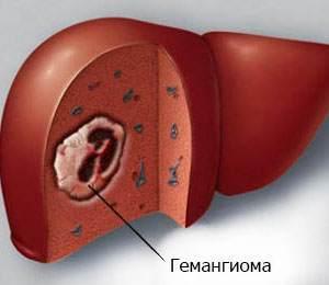кавернозная гемангиома