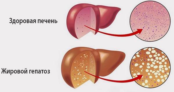 жировой гепатоз