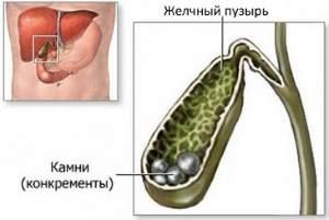 камни в желчном пузыре