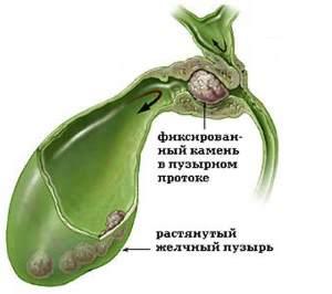 камни в желчном пузыре