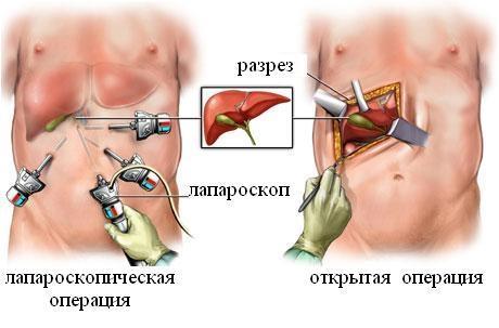удаление желчного пузыря