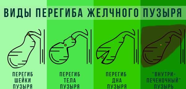 виды перегибов
