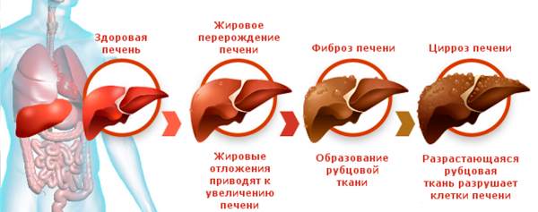 перерождение печени
