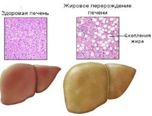 жировое перерождение печени