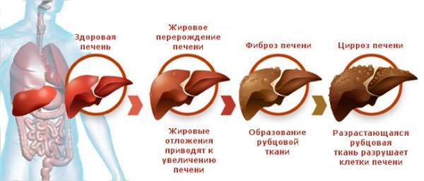 стадии поражения печени