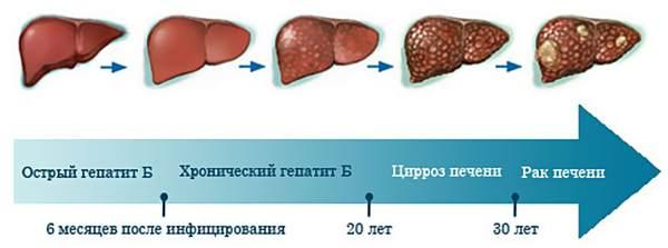 стадии гепатита