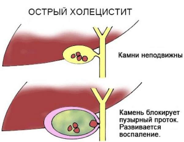 воспаление желчного пузыря