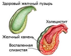 калькулезный холецистит
