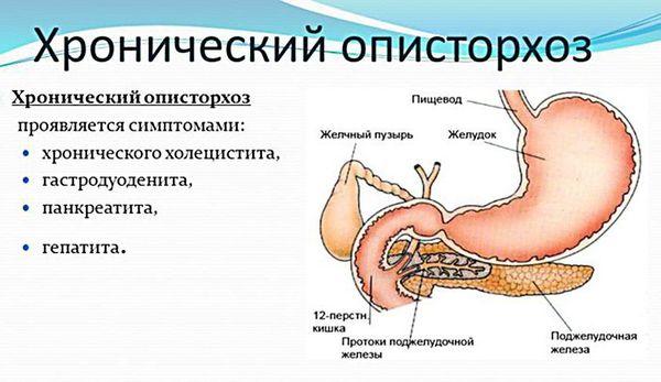 симптомы описторхоза