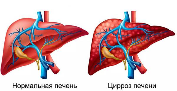 цирроз печени