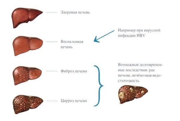 стадии болезни