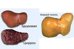 жировой гепатоз