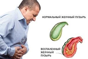 сравнение здорового желчного пузыря и воспаленного