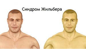 синдром Жильбера
