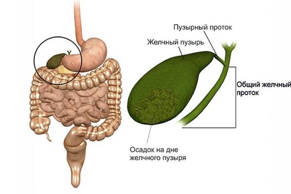 Билиарный сладж в желчном пузыре