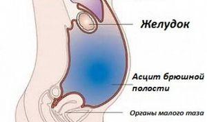 асцит