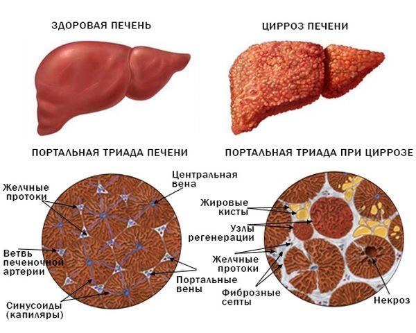 перерождение ткани печени