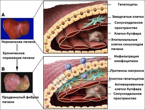 возникновение фиброза печени