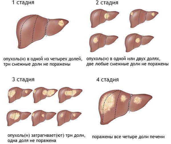 стадии поражения