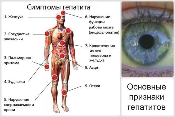 признаки гепатита