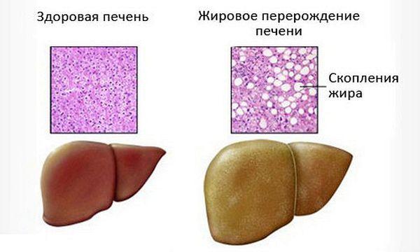жировой гепатоз печени