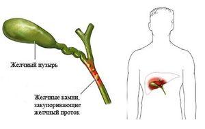 холецистит