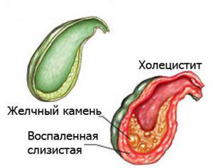 признаки холецистита