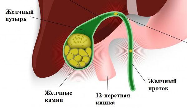 камни в желчном пузыре