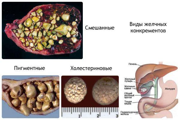 камни в желчном пузыре