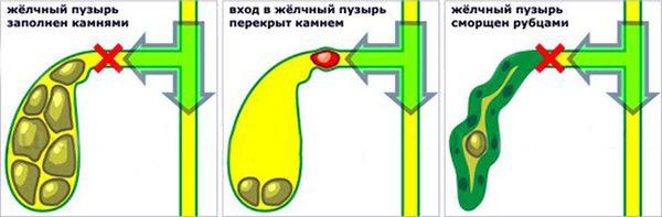 нарушение функций желчного