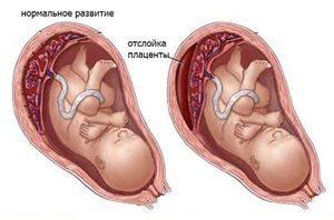 отслойка плаценты