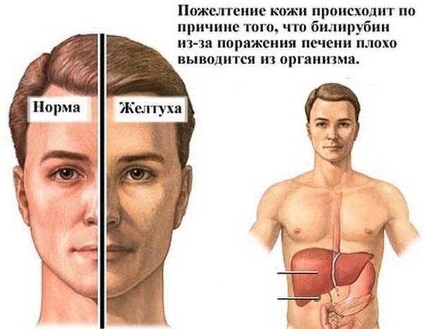 признаки желтухи