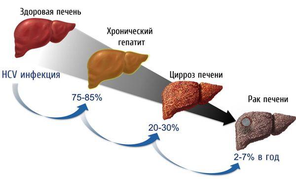 стадии деградации печени