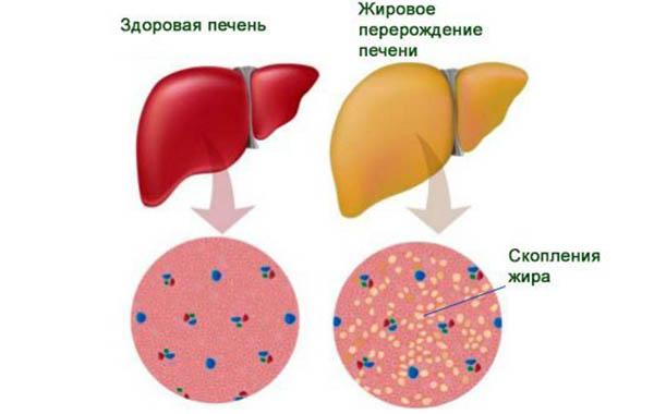 жировое перерождение печени