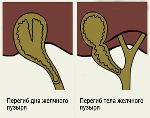 виды перегибов желчного