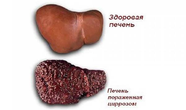 цирроз печени