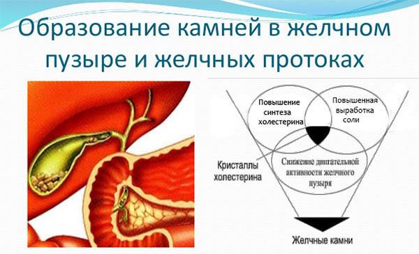 механизм образования камней