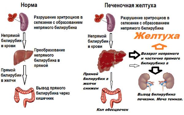 печеночная желтуха
