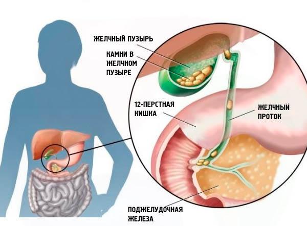 застой желчи