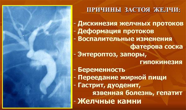 причины застоя желчи