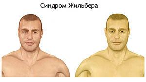 синдром Жильбера