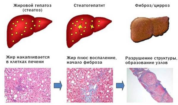 стадии болезни