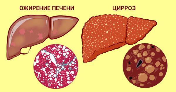 стадии деградации печени