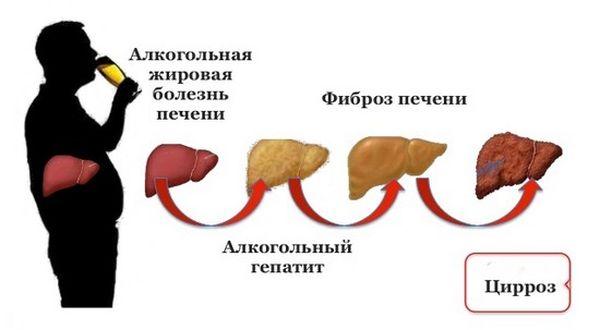 стадии алкогольной болезни печени