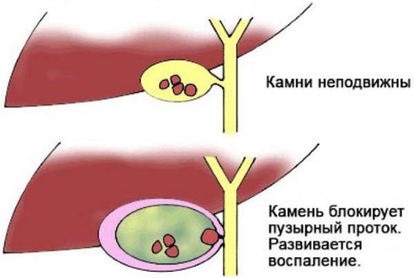 острый холецистит