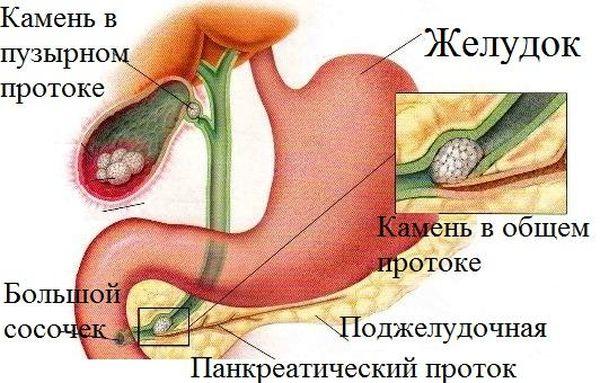 камни в желчном