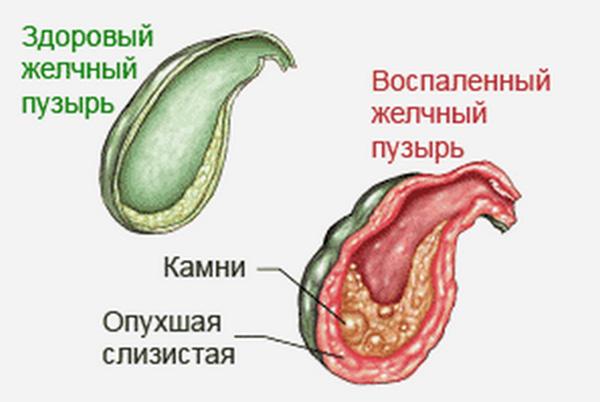 воспаленный желчный пузырь